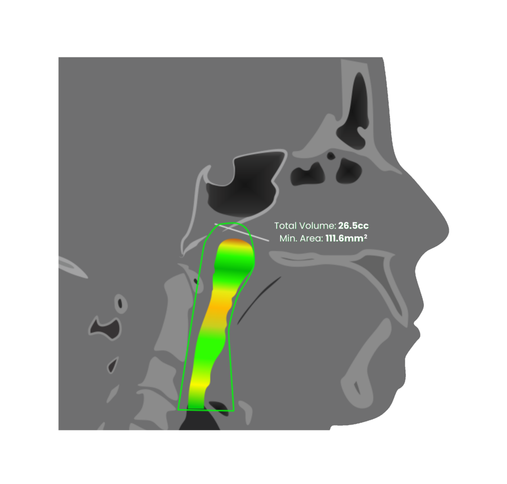 Vivos Dental Appliance in Houston Sleep Apnea Treatment